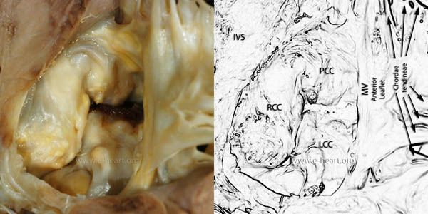 Aortic stenosis - ventricular view